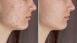 Cropped shot of a young woman's face before and after acne treatment on face. Pimples, red scars, rash on cheeks and chin. Problem skin, care and beauty concept. Allergies, dermatitis, bad nutrition