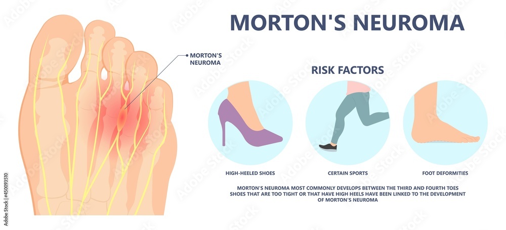 Lump In The Ball Of The Foot: Complete Guide & Key Details