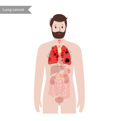 Wall Mural - Lungs cancer disease