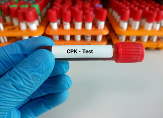 Sticker - Blood sample for Creatine Phosphokinase (CPK) enzyme test with laboratory background. Diagnosis of muscle/tissue injuries. Myocardial infection.