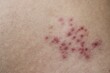 close up of shingles rash blisters flaking 