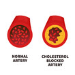 Normal blood vessel versus artery with cholesterol plaque buildup. Narrowed blood vein blocked with a clot. High cholesterol level as atherosclerotic risk. Medical concept. Vector illustration.