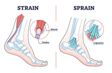 Sprain Vs Strain Anatomical Comparison As Medical Foot Injury Outline Diagram. Labeled Educational Orthopedic Muscle, Tendon And Ligament Problem Description Vector Illustration. Painful Foot Twist.