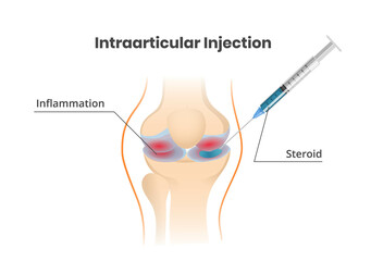 Wall Mural - Knee joint injection. Injection of the corticosteroids scientific illustration