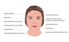 Facial Wrinkles, Illustration