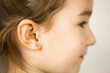 © Ольга Симонова - Ear piercing in a child - a girl shows an earring in her ear made of a medical alloy. White background, portrait of a girl with a mole on his cheek in profile.