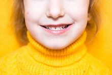 Girl Shows Her Teeth-pathological Bite, Malocclusion, Overbite. Pediatric Dentistry And Periodontics, Bite Correction. Health And Care Of Teeth, Caries Treatment, Baby Teeth. Upper Jaw Rests On Gum.