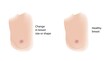 © Science RF - Healthy breast and changes in size or shape, illustration