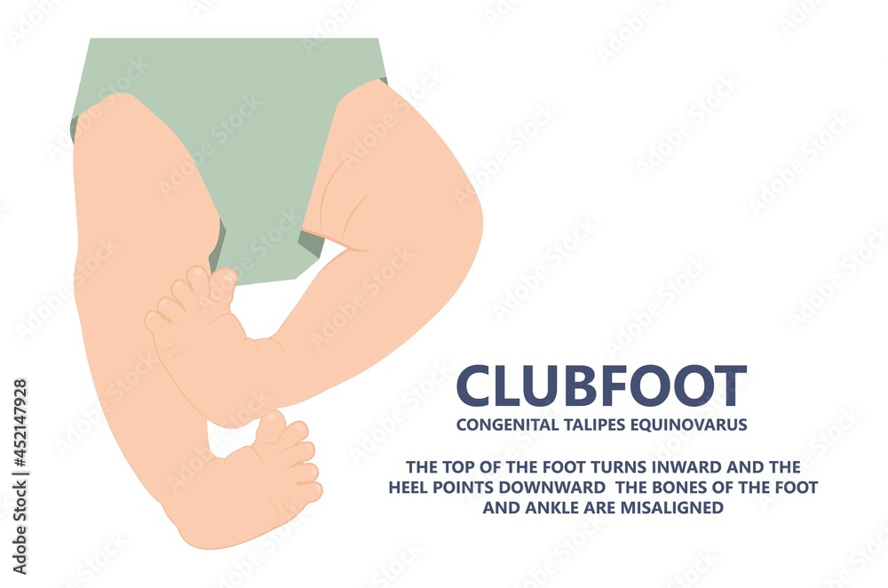 Tibia Baby Vector de Stock foot deformities infant turned inward upward birth baby ...