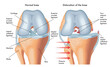 Medical illustration of symptoms of dislocated knee, with annotations.