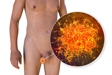 Sticker - Testicular cancer, medical 3D illustration