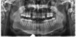 Pantogram szczęki z ubytkami zębów.