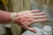 Sunburn on human hand. Selective focus with shallow depth of field.