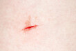 © ANGHI - Cut on the body. Fresh wound on the leg with blood, skin texture. Woman's leg, red scratch is bleeding, first aid