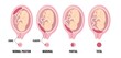 Different Placental Locations During Pregnancy. Normal, marginal, partial and total previa.