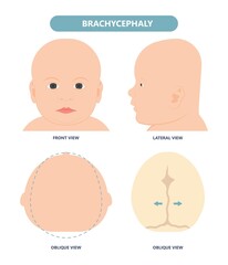 Wall Mural - craniosynostosis helmet pillow flat head autism brain skull bone deformity baby infant child newborn defect birth anterior Metopic Born genes genetic position sleep shape deformation tummy time 