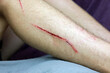 A bleeding cut wound on a leg