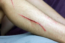 A Bleeding Cut Wound On A Leg