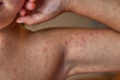 © JORGE CORCUERA - allergic rash on the body of the patient. 5 year old girl.
