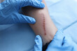 © megaflopp - Doctor in rubber protective gloves examining patient scar in clinic closeup