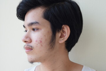 Young man 15 year old. With full face of acne problem or pimple on face Asian young boy