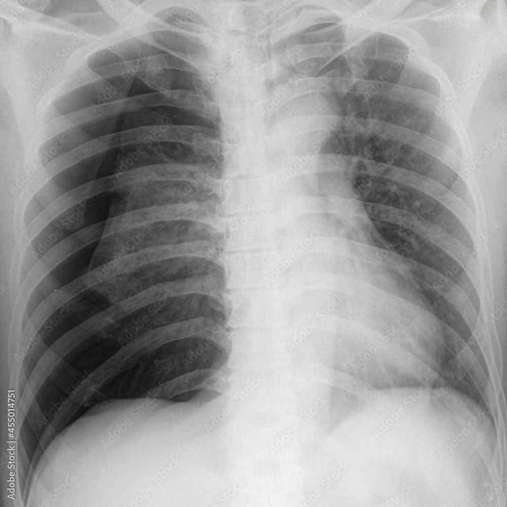 Pneumothorax chest x ray radiology image 