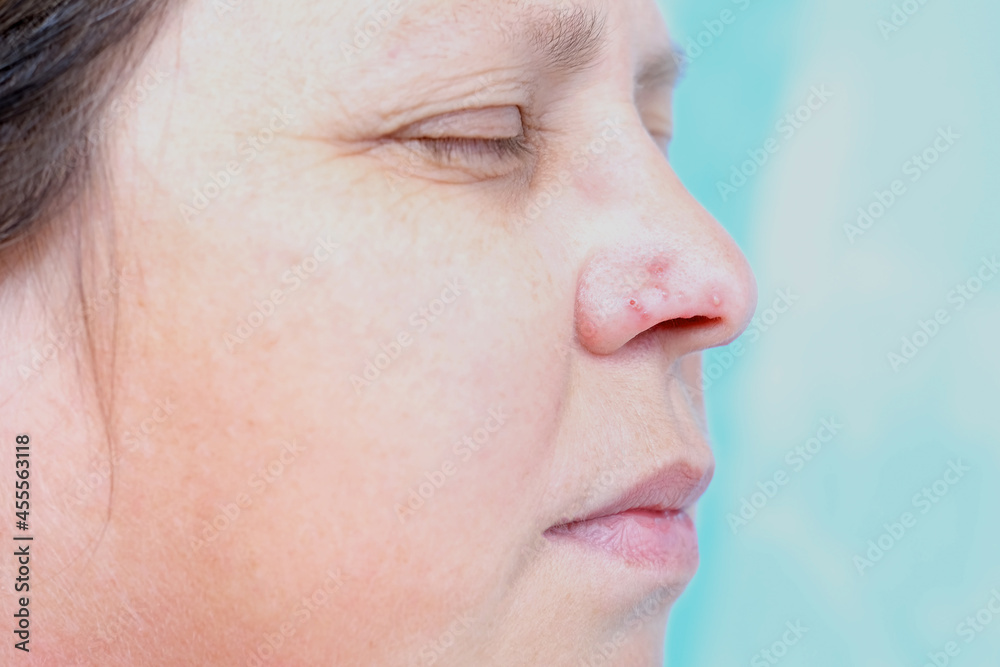 woman with blisters from herpes on the wings of the nose, viral skin ...