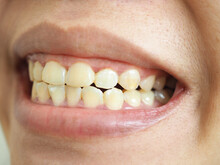Yellow Teeth Of A Woman. Closeup Photo, Blurred.