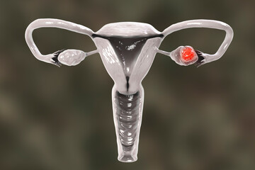 Sticker - Ovarian cancer, 3D illustration