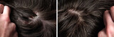 Before and after dandruff treatment shampoo on hair woman. Dandruff in the hair. Flaky scalp. Seborrhea.