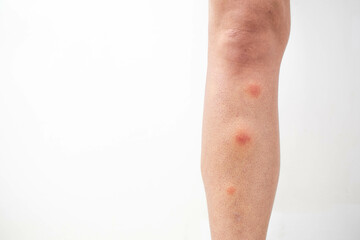 Mosquito bites on the leg. Mosquito bites close up shot.