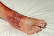 © Sarawut - Health care and medical concept, Selective focus of a man right foot on white bed linen with blisters, Fresh wound and blood from skin burns on ankle, Accident hot water fall with scald on a men feet.