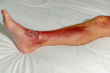 Health care and medical concept, Selective focus of a man leg and foot laid on white bed linen with blisters, Fresh wound from skin burns on ankle, Accident hot water fall with scald on a men feet.