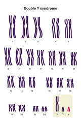 Wall Mural - Human karyotype of Double y syndrome. XYY. Male has an extra Y chromosome.