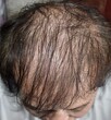Thinning or sparse hair, male pattern hair loss
