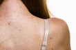 Woman with skin problem acne on back