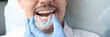 © H_Ko - Dentist trying on mouthguard for man patient