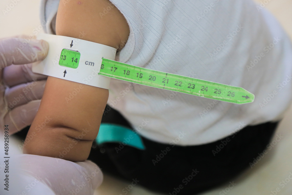 Measuring malnutrition using strap MUAC mid-upper-arm-circumference. A ...