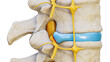© Matthieu - Herniated disc with spinal nerve compression 3D rendering illustration lateral view isolated on white background. Backbone or spinal column injury, anatomy, medical, science concepts.