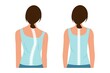 Good posture and bad posture. Chiropractic before after image. Scoliosis.Woman's body and backbone.