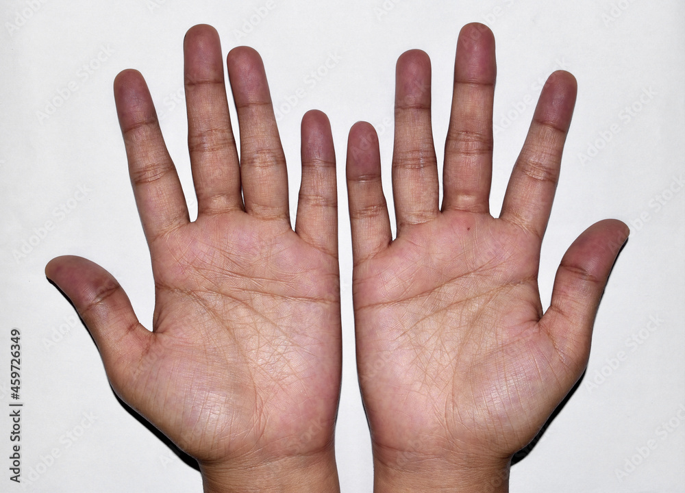 Cyanotic hands or peripheral cyanosis or blue hands at Asian young ...