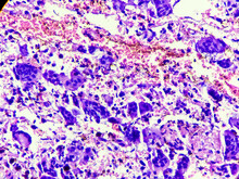 Osteoclast Like Giant Cells. Light Micrograph Of A Giant Cell Tumour Of Lower End Of Right Femur Showing Giant Cells Derived From Osteoclasts.