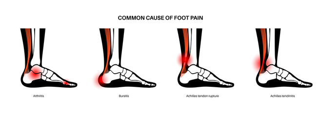 Poster - Achilles tendon injury