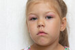 Portrait of caucasian little girl of five years old with swelling eyes because of allergy, conjunctevitis and adenoids on white background