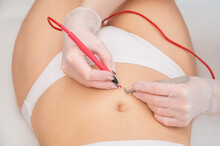 Woman On Electro Epilation On Her Tummy. Permanent Hardware Removal Of Unwanted Abdominal Hair.
