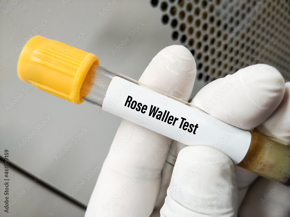 Blood sample for rose waller test, haemagglutination slide test ...