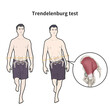 © kyungmin - Trendelenburg test 검사. 중둔근 검사