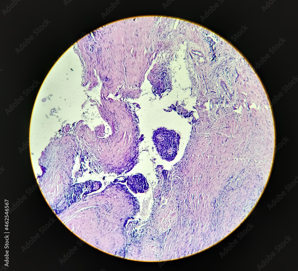 Breast Cancer Awareness, ductal carcinoma in situ (DCIS): Tumor cells ...