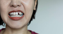Girl's Teeth, Missing Teeth, Bad Dental Health