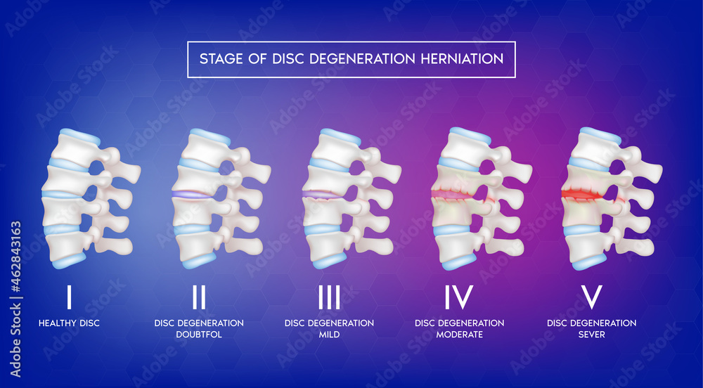 Stage of disc degeneration herniation. Spine disease, normal backbone ...